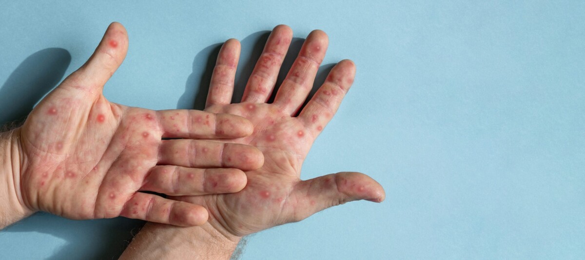 Филиппины ищут вакцины против оспы для защиты от Mpox