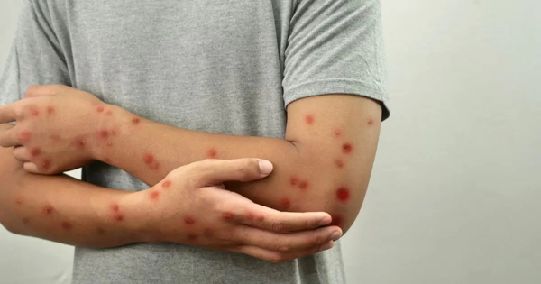Зарегистрированные случаи Mpox на Филиппинах